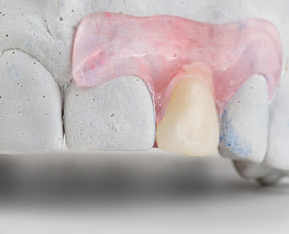 入れ歯(一部自由診療)