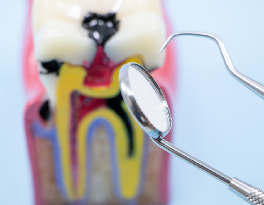 根管治療の目的