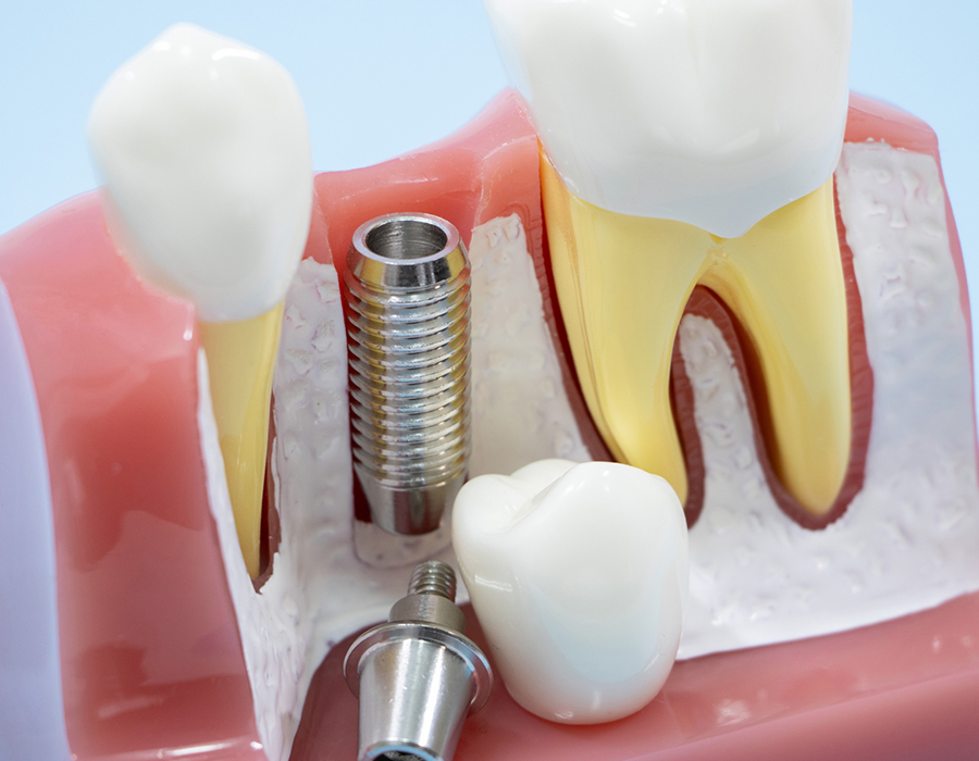 治療後のメンテナンス