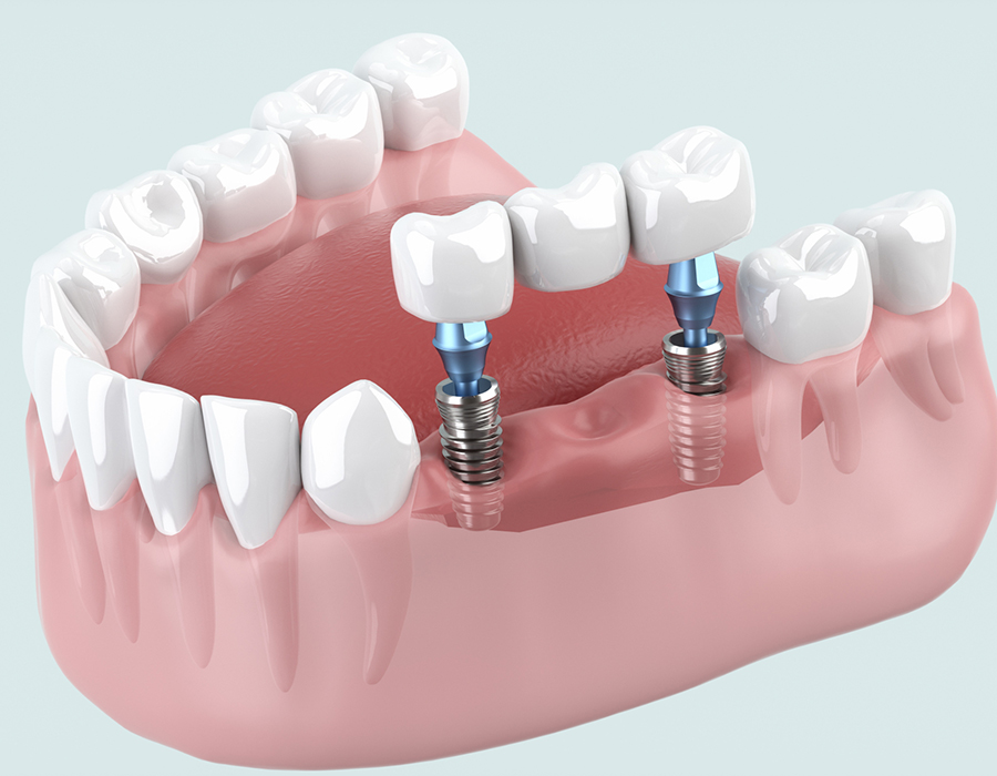 インプラント治療とは