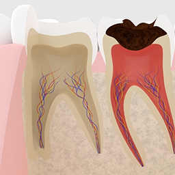 重度のむし歯がある